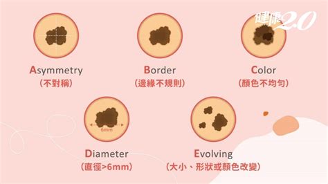 右手大拇指突然長痣|別把癌當痣！5部位冒黑點恐是惡性黑色素瘤 台大醫師。